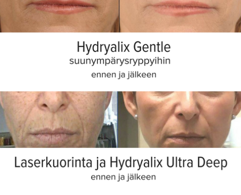 Ennen ja jälkeen — täyteainehoito