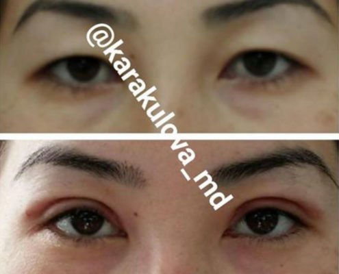 Double eyelid surgery