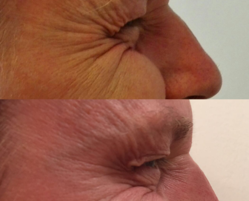Botox-hoito — ennen ja jälkeen