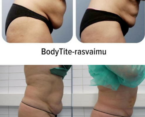 BodyTite-rasvaimu ennen ja jälkeen BodyTite rasvaimu ennen jälkeen