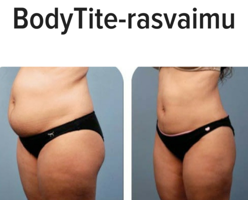BodyTite-rasvaimu ennen ja jälkeen Cityklinikka BodyTite rasvaimu ennen jälkeen