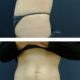 Ennen ja jälkeen abdominoplastia Ennen ja jälkeen abdominoplastia