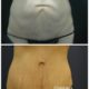 Ennen ja jälkeen — abdominoplastia Ennen ja jälkeen — abdominoplastia