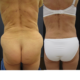 ennen ja jälkeen selkäplastia abdominoplastia