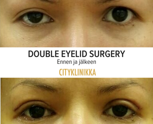 Double eyelid surgery ennen ja jälkeen