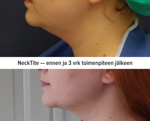 NeckTite - ennen ja jälkeen