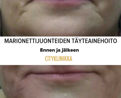 Täyteainehoito marionettijuonteet - ennen ja jälkeen