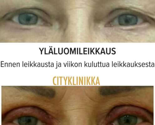 Yläluomileikkaus - ennen ja jälkeen