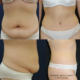 Ennen ja jälkeen – abdominoplastia, plastiikkakirurgian erikoislääkäri, tri Riikka Veltheim