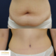 Ennen ja jälkeen – vatsanpeitteiden korjaus, plastiikkakirurgian erikoislääkäri Riikka Veltheim Ennen ja jälkeen – abdominoplastia, plastiikkakirurgian erikoislääkäri, tri Riikka Veltheim