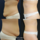 Ennen ja jälkeen –abdominoplastia, plastiikkakirurgi Riikka Veltheim Ennen ja jälkeen – abdominoplastia, plastiikkakirurgian erikoislääkäri, tri Riikka Veltheim