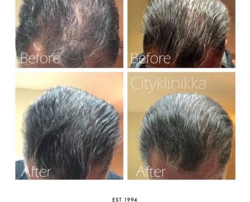 hairlase-ennen-ja-jalkeen-eroon-kaljuuntumisesta-eroon-hiustenlahdosta